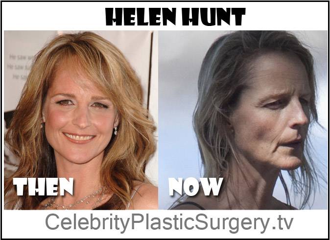 helen-hunt-before-plastic-surgery.jpg