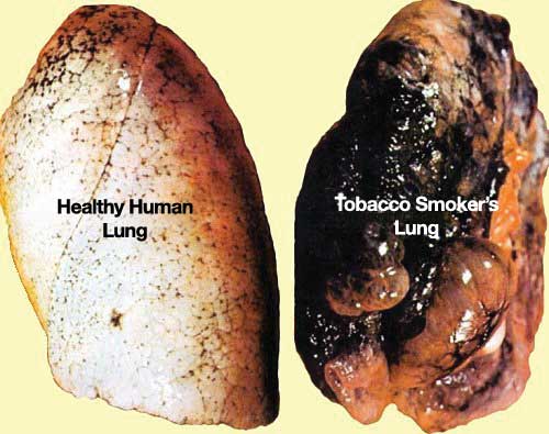 Condition-Of-Smoker-Lungs-Lung-Cancer.jpg