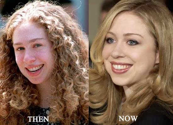 Chelsea-Clinton-nose-job-before-after.jpg