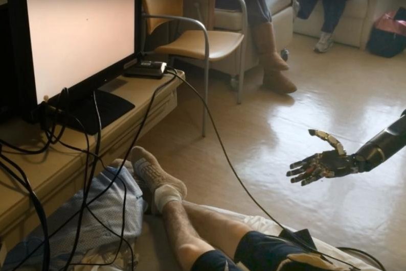 Man-moves-prosthetic-arm-with-his-mind-in-proof-of-concept-study.jpg