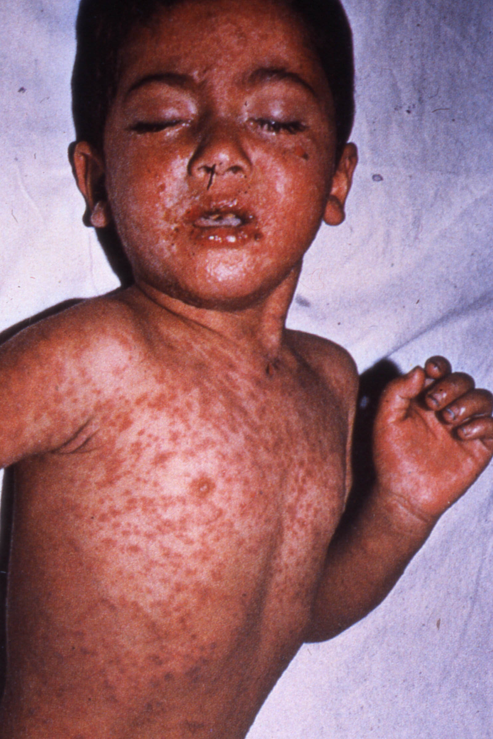 measles_3.jpg