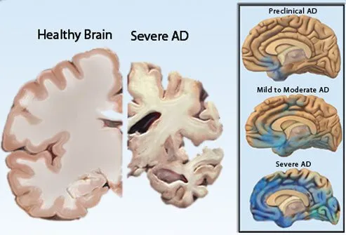 dementia_s6_healthy_brain_severe_ad.jpg