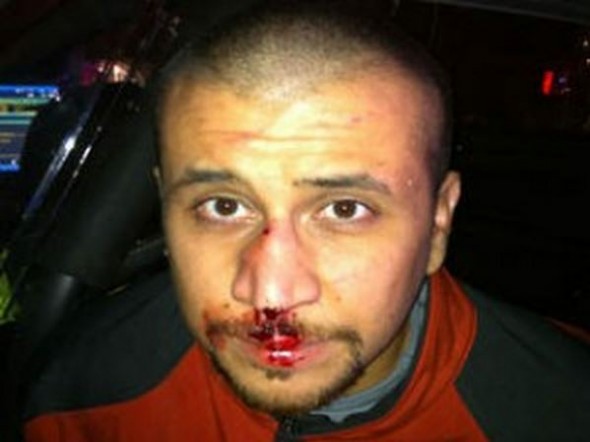 George-Zimmerman-bloody-nose-590x442.jpg
