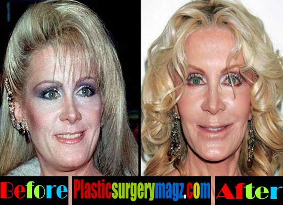 Joan-Van-Ark-Plastic-Surgery-Gone-Wrong.jpg