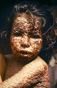 230px-Child_with_Smallpox_Bangladesh.jpg
