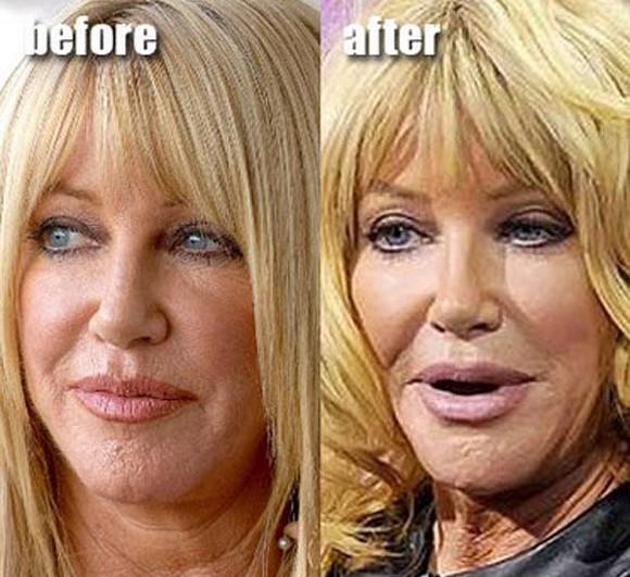 Suzanne-Somers-plastic-surgery-gone-wrong.jpg
