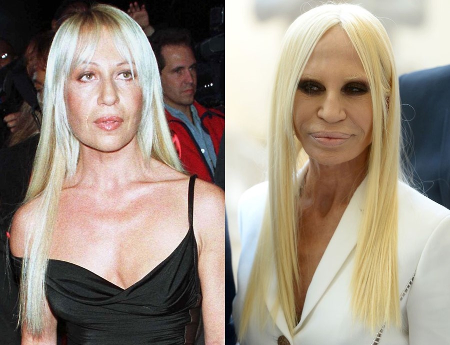 Donatella-Versace-before-and-after-plastic-surgery-04.jpg