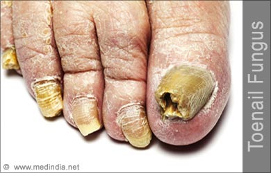 toenail-fungus.jpg