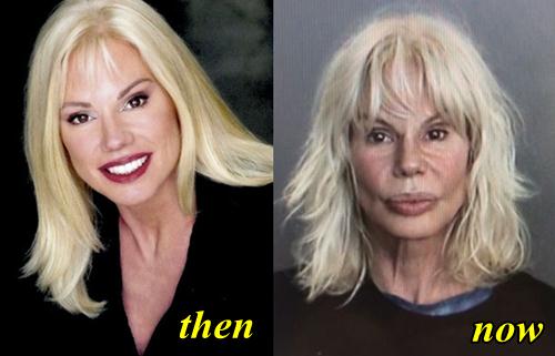 Bree-Walker-Plastic-Surgery-Before-and-After.jpg