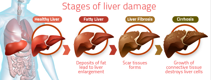 alcoholic-fatty-liver-disease.jpg