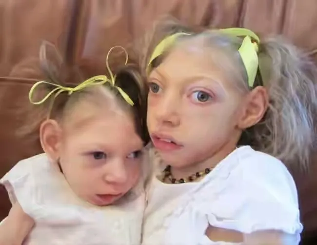 1454267494-zika-texas-children-born-with-microcephaly.webp