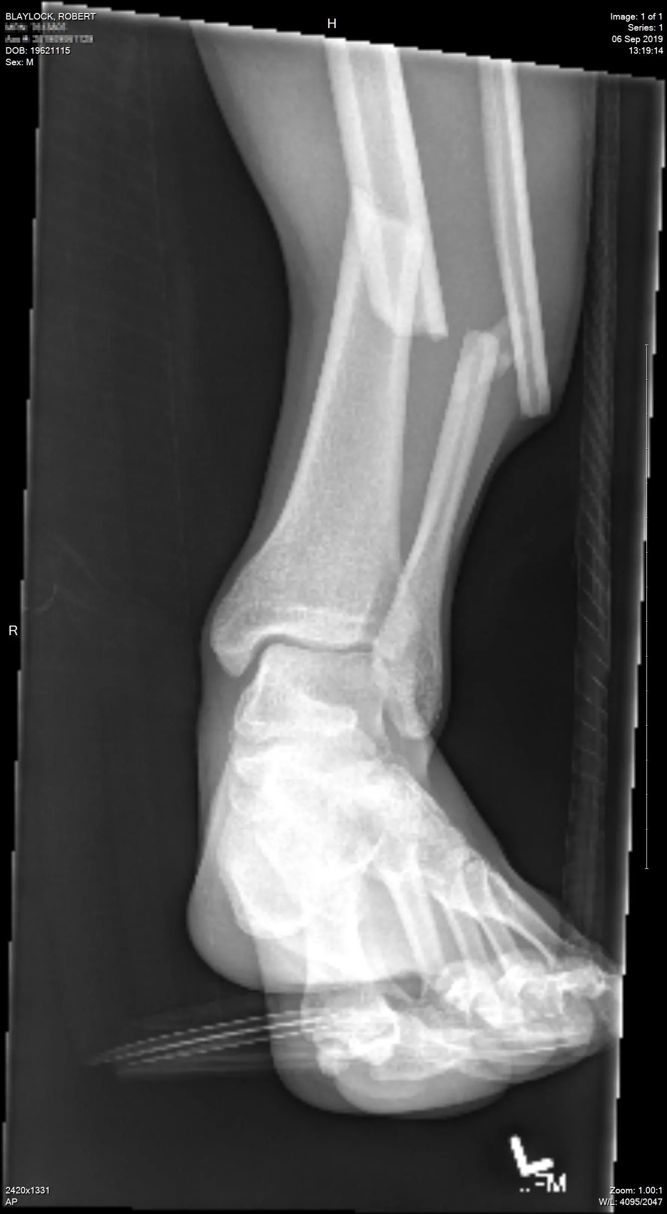 20190906_131914_Ankle0.webp