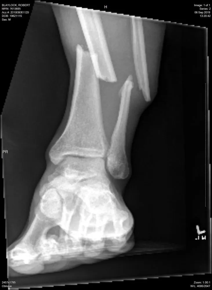 20190906_132042_Ankle1.webp