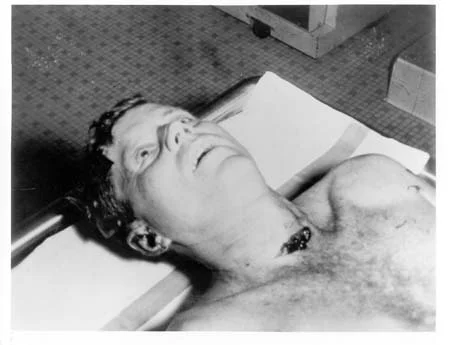 A_picture_of_President_Kennedy's_head_and_shoulders_taken_at_the_autopsy.webp