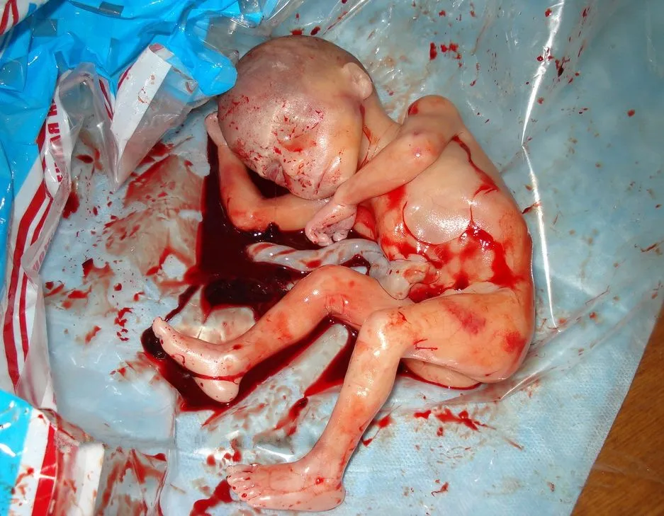 aborted-late-term-baby-jpg.544618