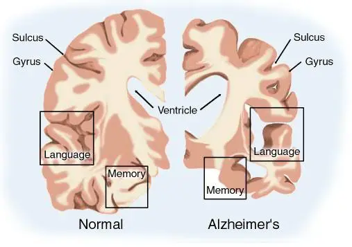 Alzheimer.webp