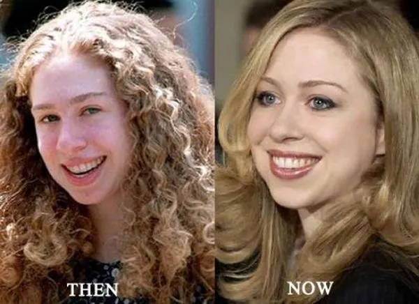 Chelsea-Clinton-plastic-surgery-before-after.jpg