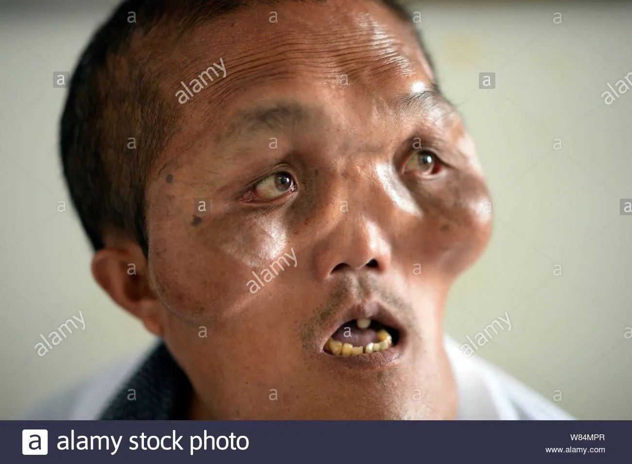 chinese-villager-xia-yuanhai-who-has-an-alien-like-deformed-face-is-pictured-at-chongqing-xin...webp