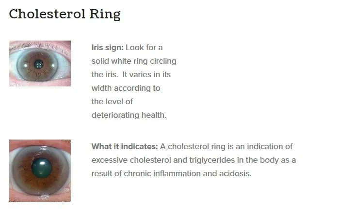 cholesterol irises.webp