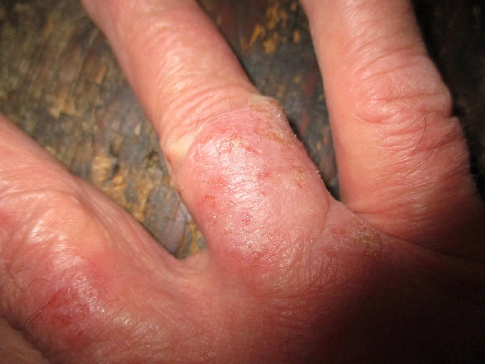 dermatitis.webp