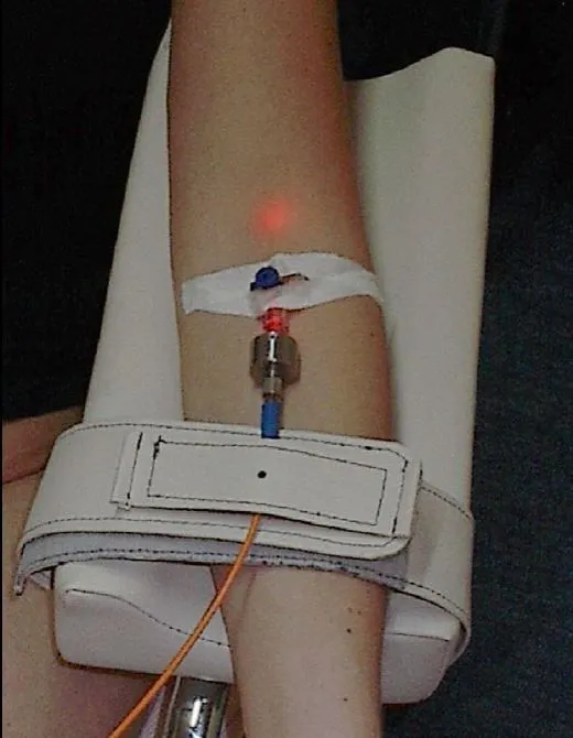 Intravenous blood irradiation.webp