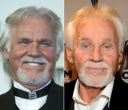 Kenny rogers before after.webp