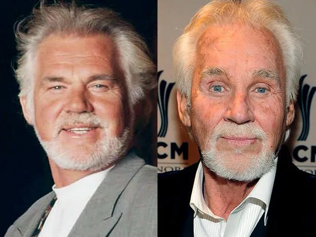 kennyrogers-beforeafter.webp
