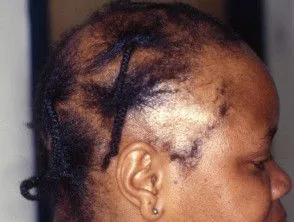 traction-alopecia-3__ProtectWyJQcm90ZWN0Il0_FocusFillWzI5NCwyMjIsIngiLDFd.webp