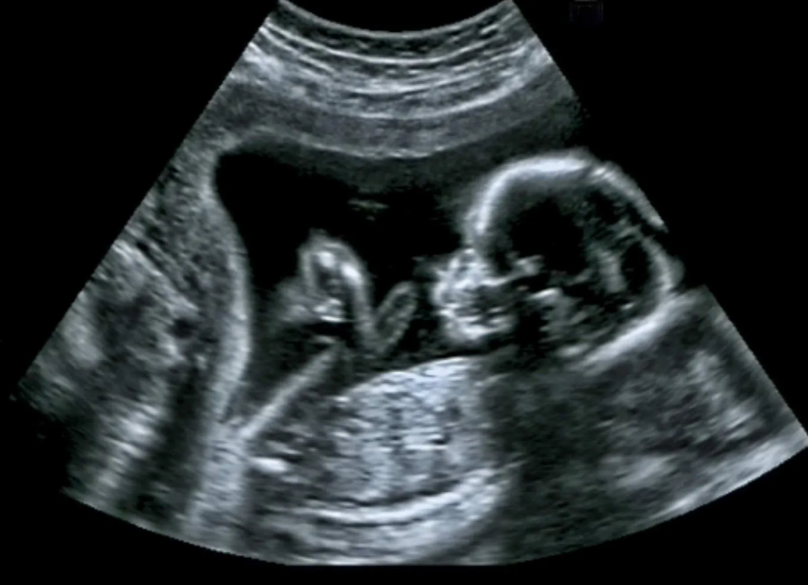 Ultrasound-of-baby-in-mothers-womb..webp