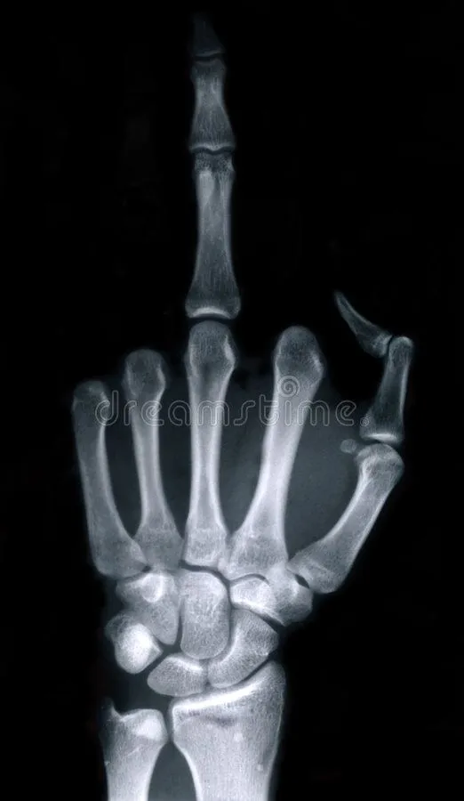 x-ray-hand-middle-finger-7279508.webp