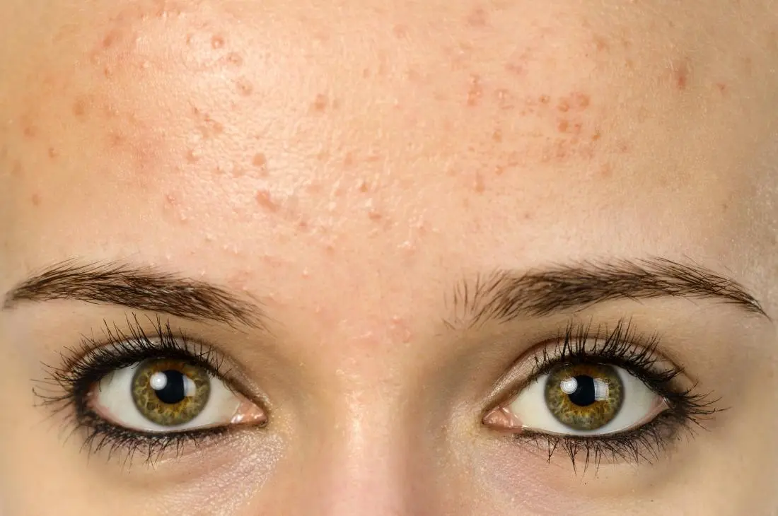 young-woman-with-forehead-acne.webp