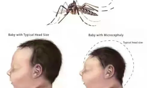 zika.webp