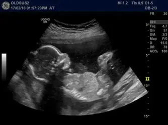 Ultrasound.webp