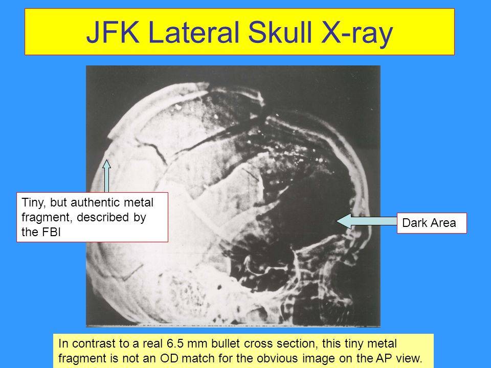 JFK+Lateral+Skull+X-ray.jpg