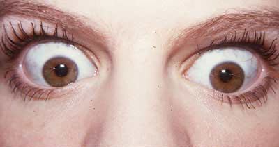 bulging+eyes.jpg