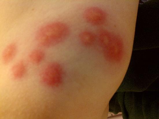 bed-bug-bites.jpg