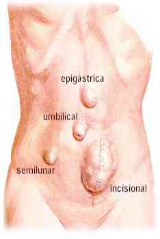 ventral-hernias.jpg