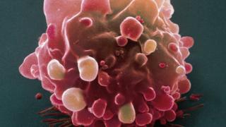 _88503639_bowelcancercell_spl.jpg