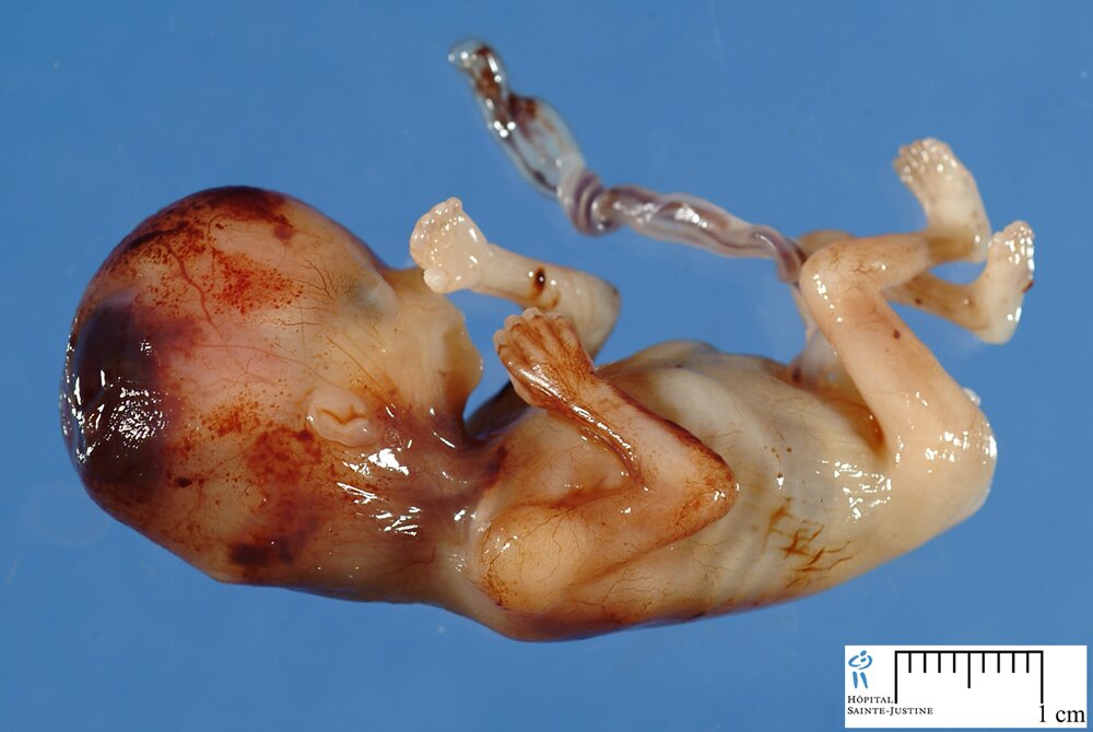jpg_fetus_12w_formalin_12_2.jpg