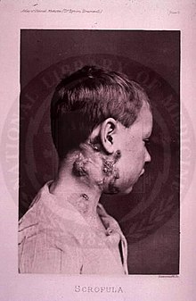 220px-Scrofula.jpeg