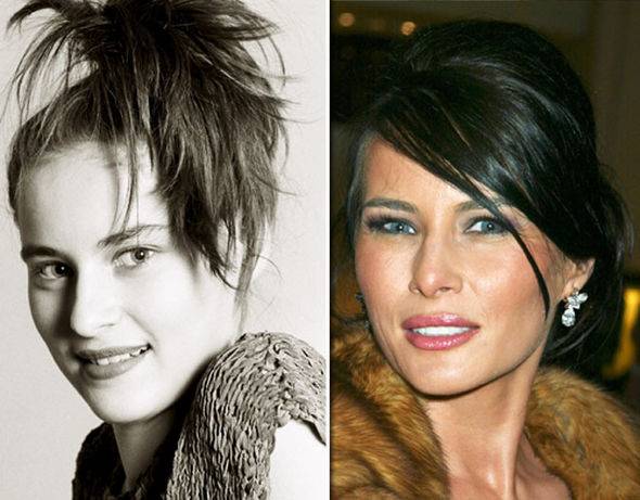 Melania-Trump-plastic-surgery-BEFORE-and-after-795122.jpg