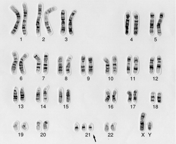 down-karyotype.jpg