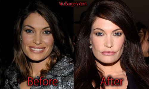 Kimberly-Guilfoyle-Plastic-Surgery.jpg