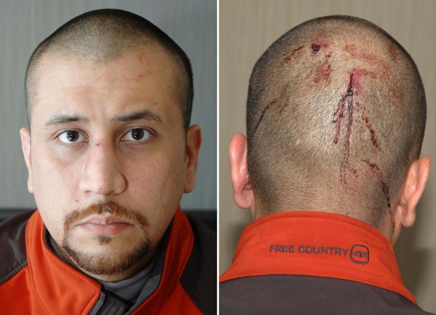george_zimmerman_injury.jpg