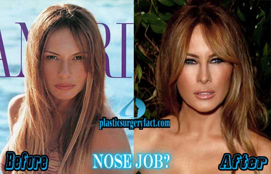 Melania-Trump-Plastic-Surgery-Nose-Job.jpg