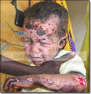 Darfur-baby-burnt-bombing-r.jpg