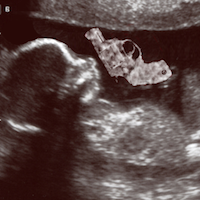 fetus200.png