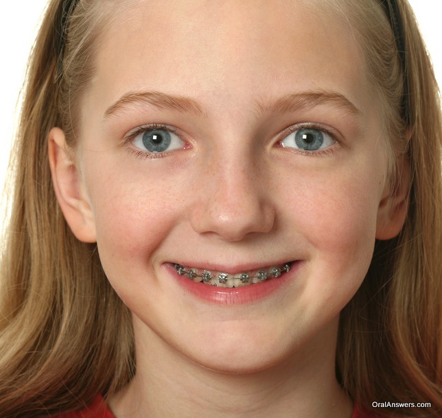 young_girl_braces_smiling.jpg