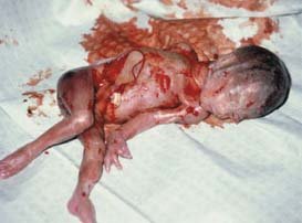 partial+birth+abortion.jpg