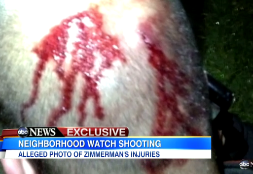 graphic-photo-broken-nose-could-be-critical-to-george-zimmermans-defense.jpg